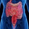 CROHN  HASTALIĞI