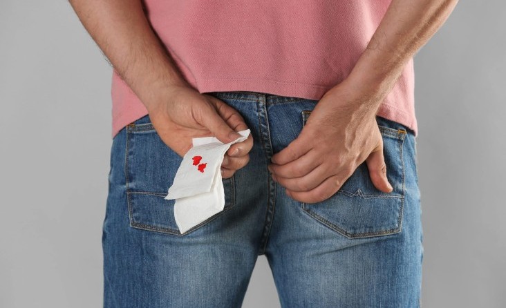 ANAL SİĞİLLER (WART-KONDİLOM)