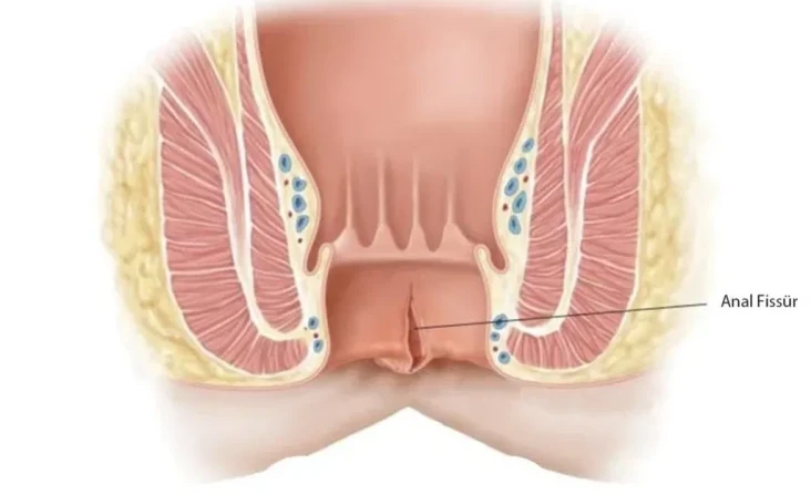 ANAL FİSSÜR