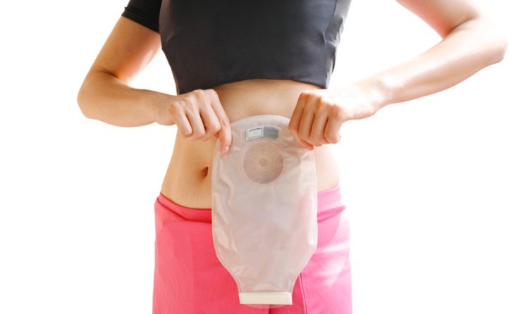 OSTOMİ