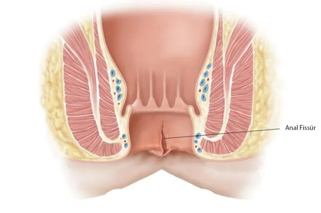 ANAL FİSSÜR