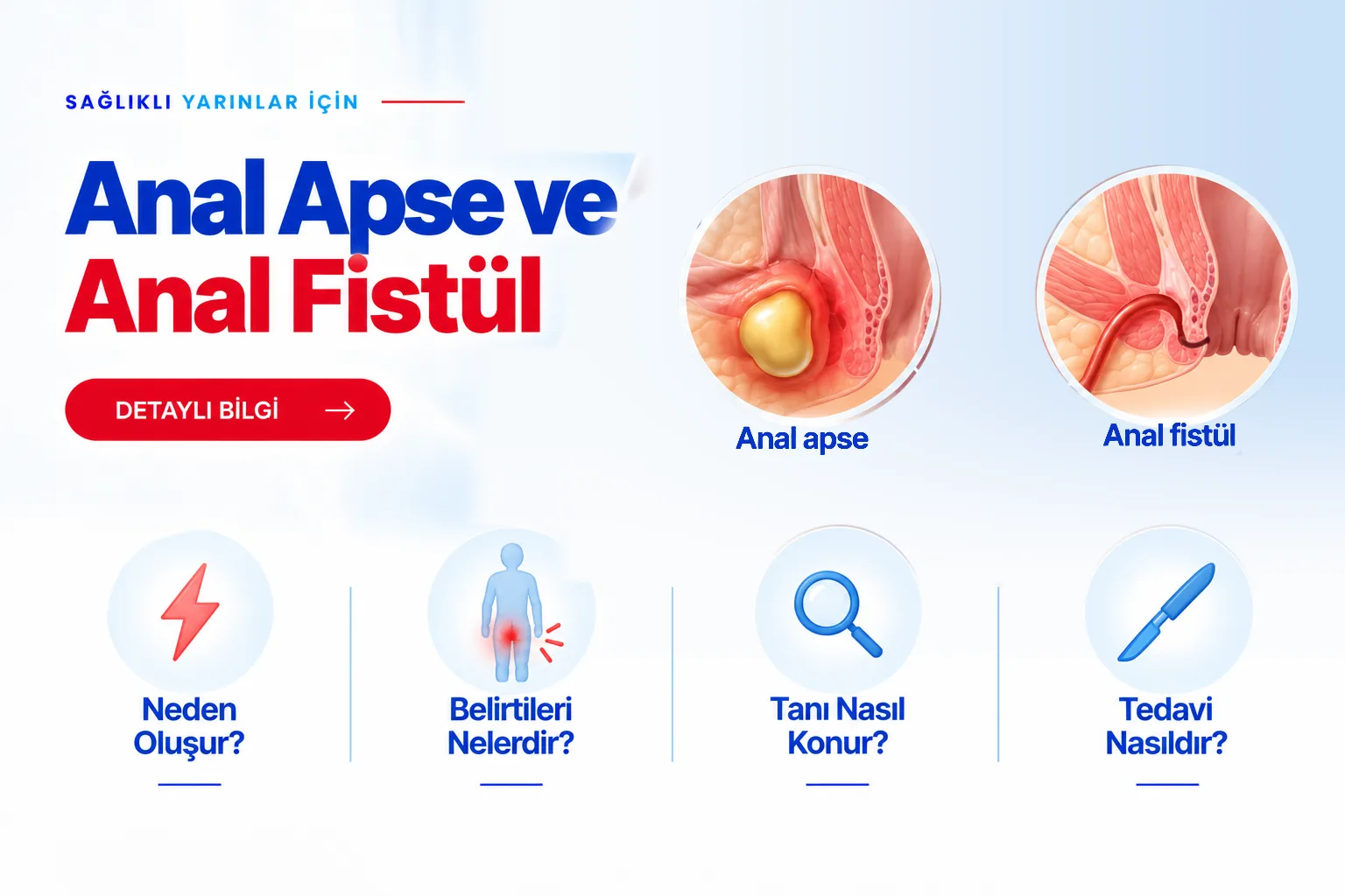 Anal Apse ve Anal Fistül – hasta bilgilendirme görseli