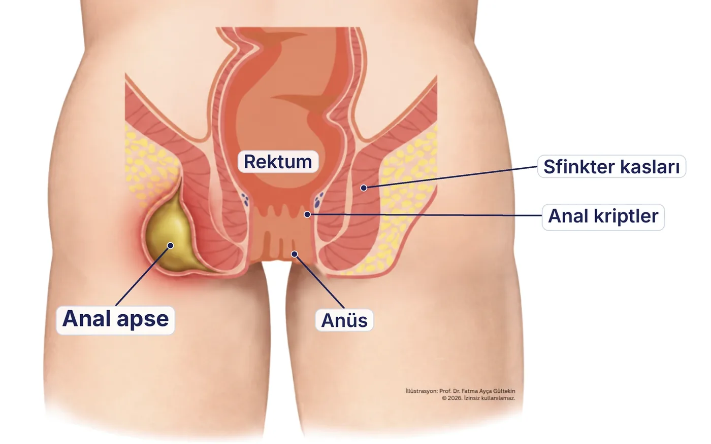 Anal apse şeması: makat çevresinde iltihap toplanması