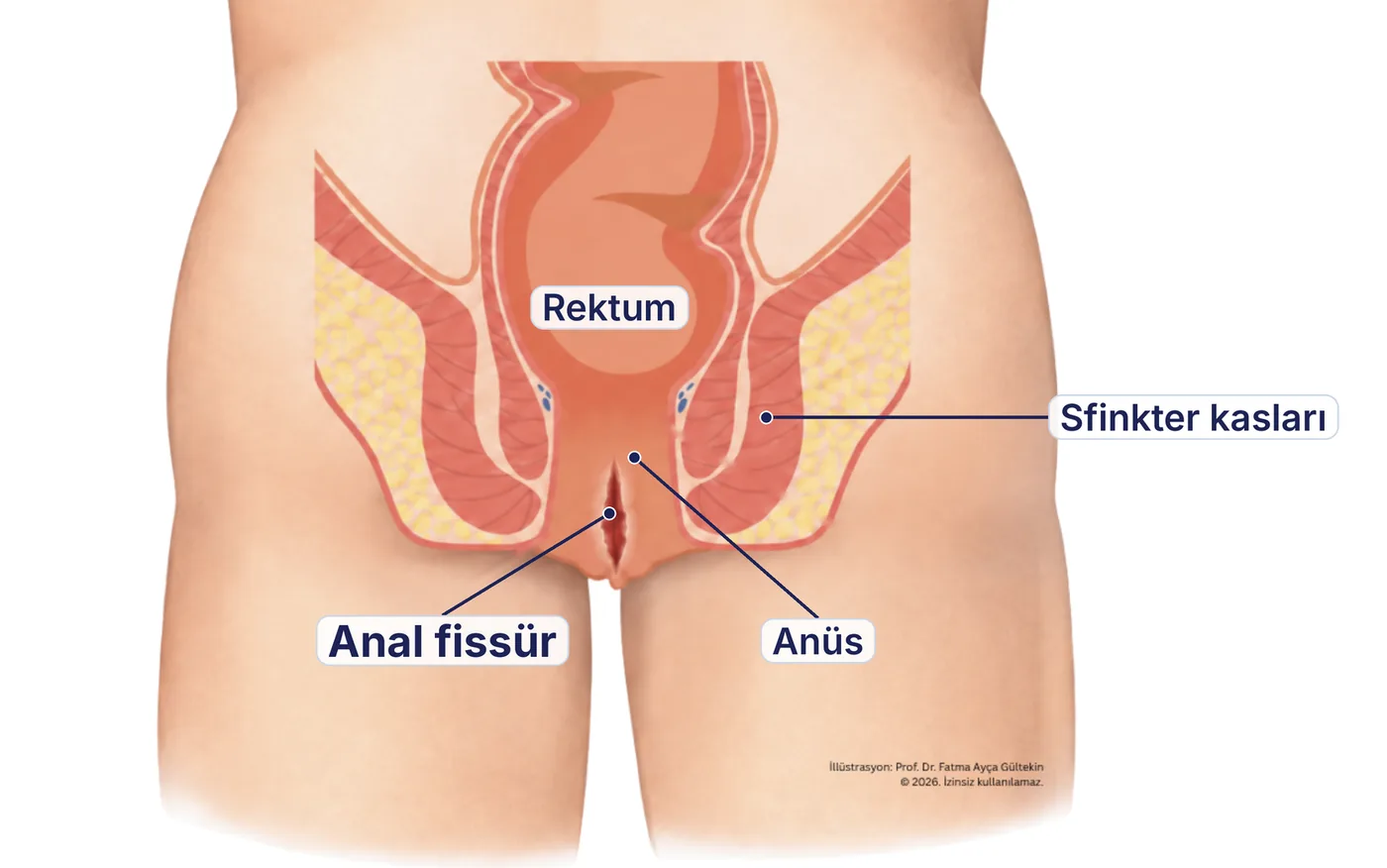 Anal fissür şeması: makat girişindeki çatlak, sfinkter kasları ve rektum