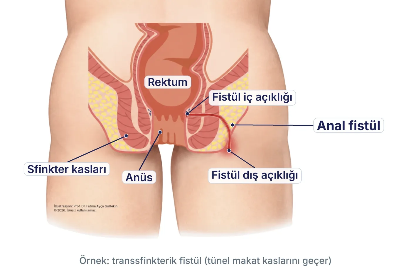 Anal fistül şeması: iç açıklık, sfinkter kaslarını geçen tünel ve dış açıklık