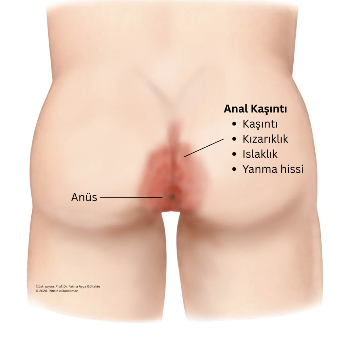 Anal kaşıntı çizimi: makat çevresinde kızarıklık, nem ve tahriş