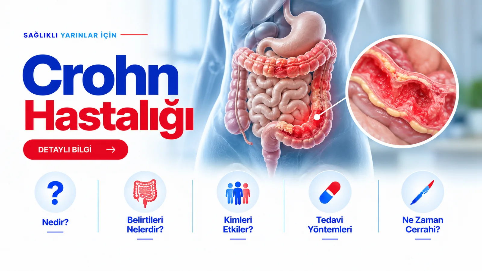Crohn Hastalığı – hasta bilgilendirme görseli