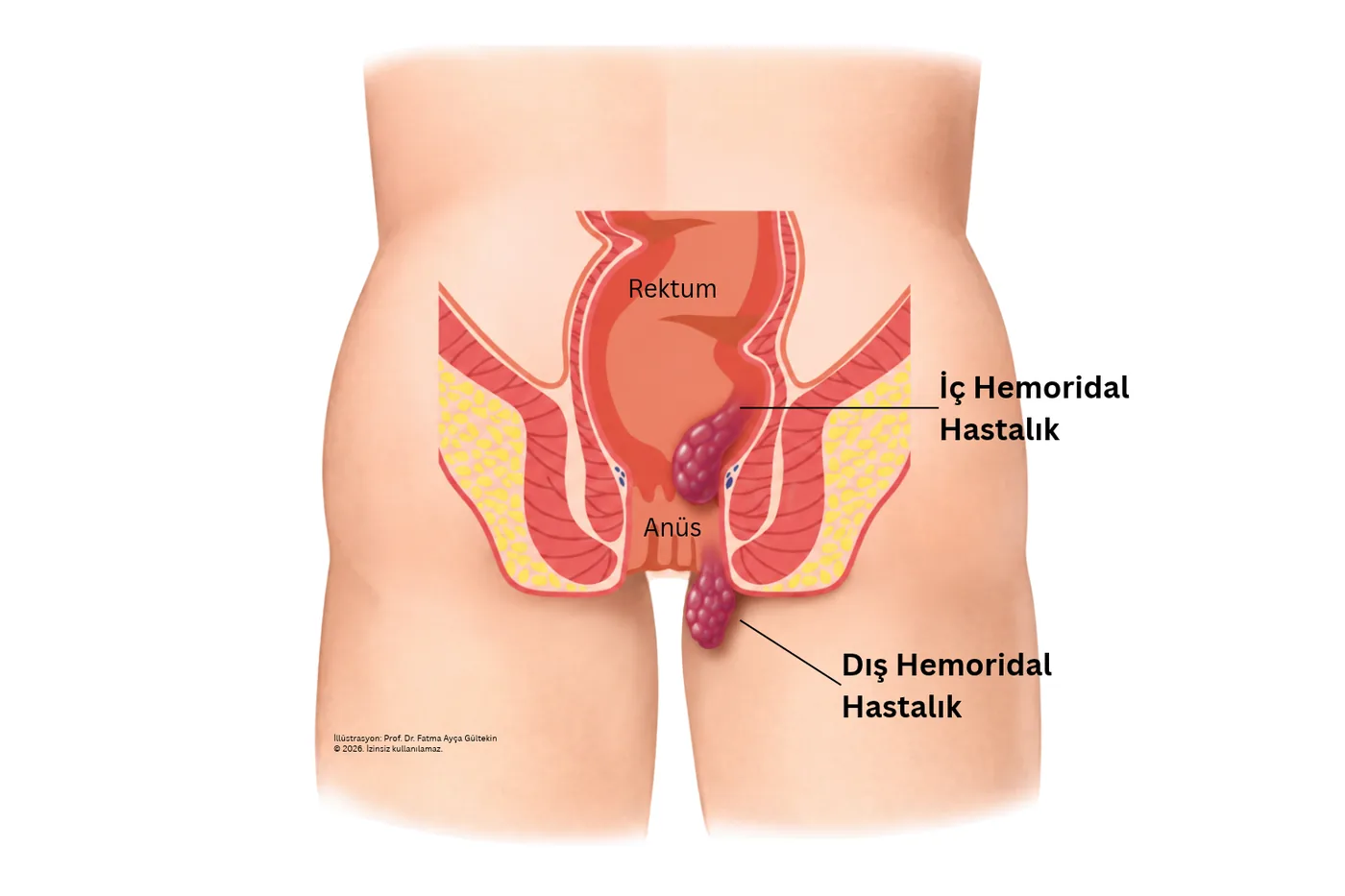 İç ve dış hemoroidal hastalık çizimi: rektum, anüs, makat kanalı içinde iç hemoroid ve dışında dış hemoroid