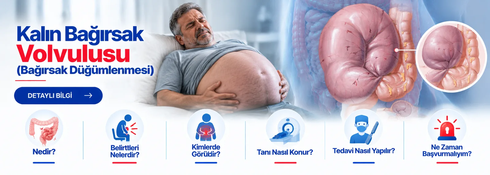 Kalın Bağırsak Volvulusu (Bağırsak Düğümlenmesi) – hasta bilgilendirme görseli