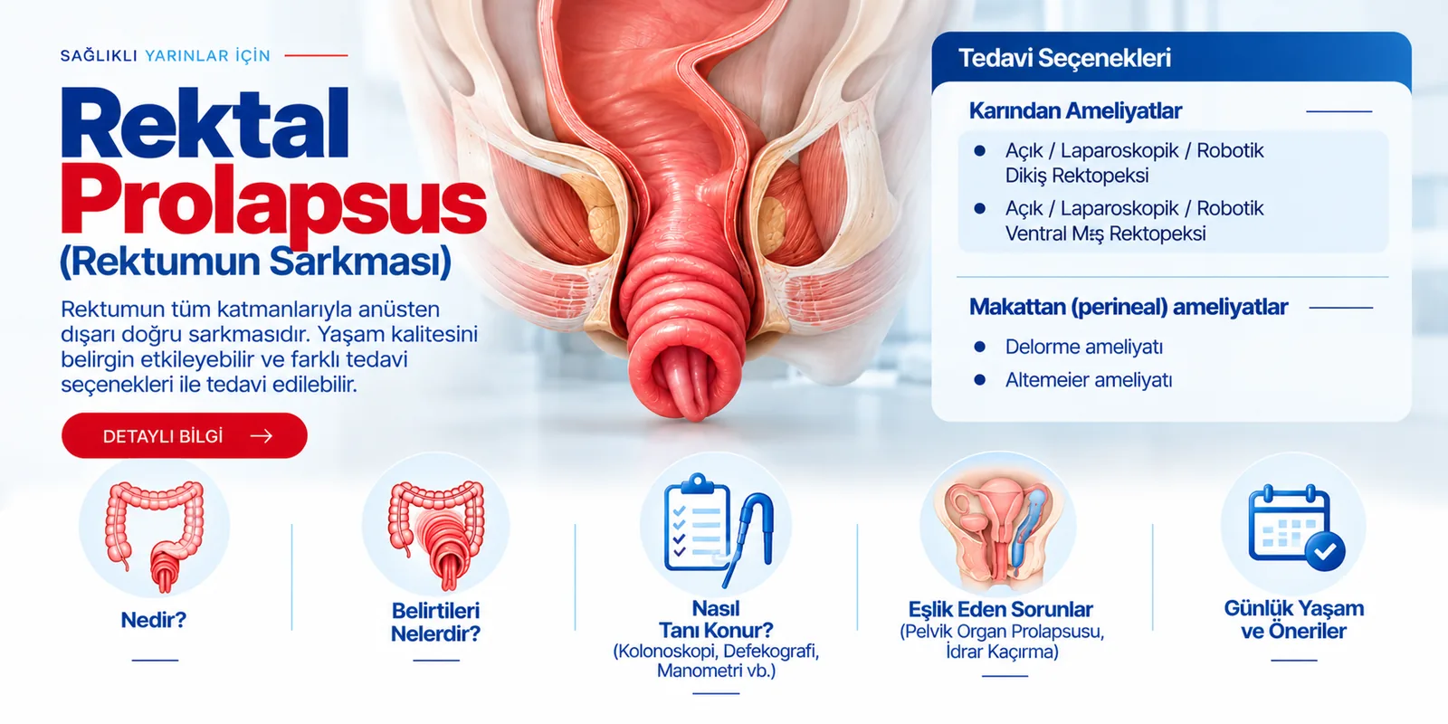 Rektal Prolapsus (Rektumun Sarkması) – hasta bilgilendirme görseli