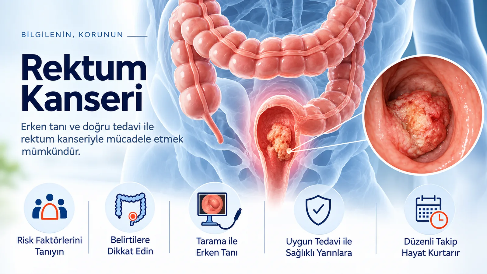 Rektum Kanseri – hasta bilgilendirme görseli